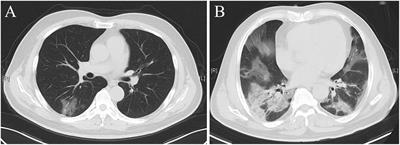 Implications of LDH in patients with coronavirus disease 2019 pneumonia